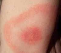 borrelioz.jpg