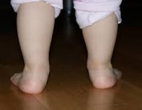 valgus-stopi-1.jpg
