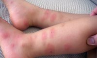 allergiya-na-ukusy-klopov-4.jpg